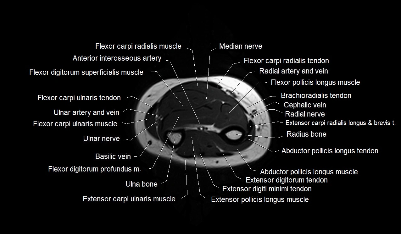 MRI 3T forearm axial cross sectional anatomy image 36.webp